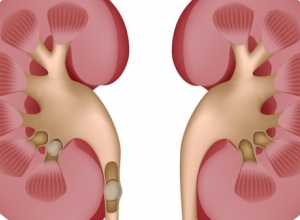 Uống nhiều bia rượu có tăng kích thước sỏi thận?